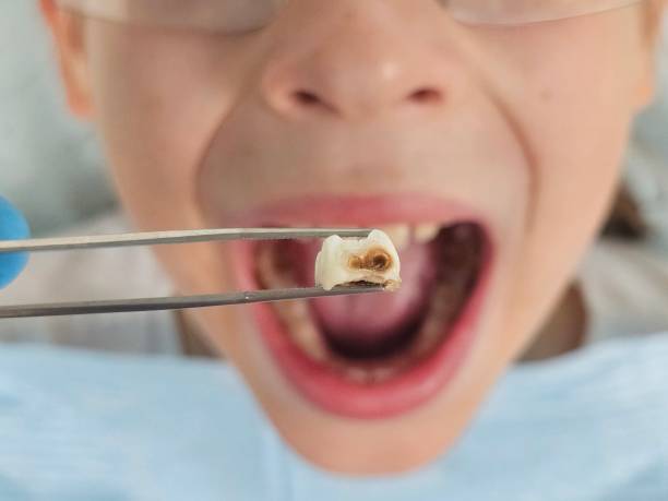 Best Emergency Treatment for Dental Infections or Abscesses in Florence, CO